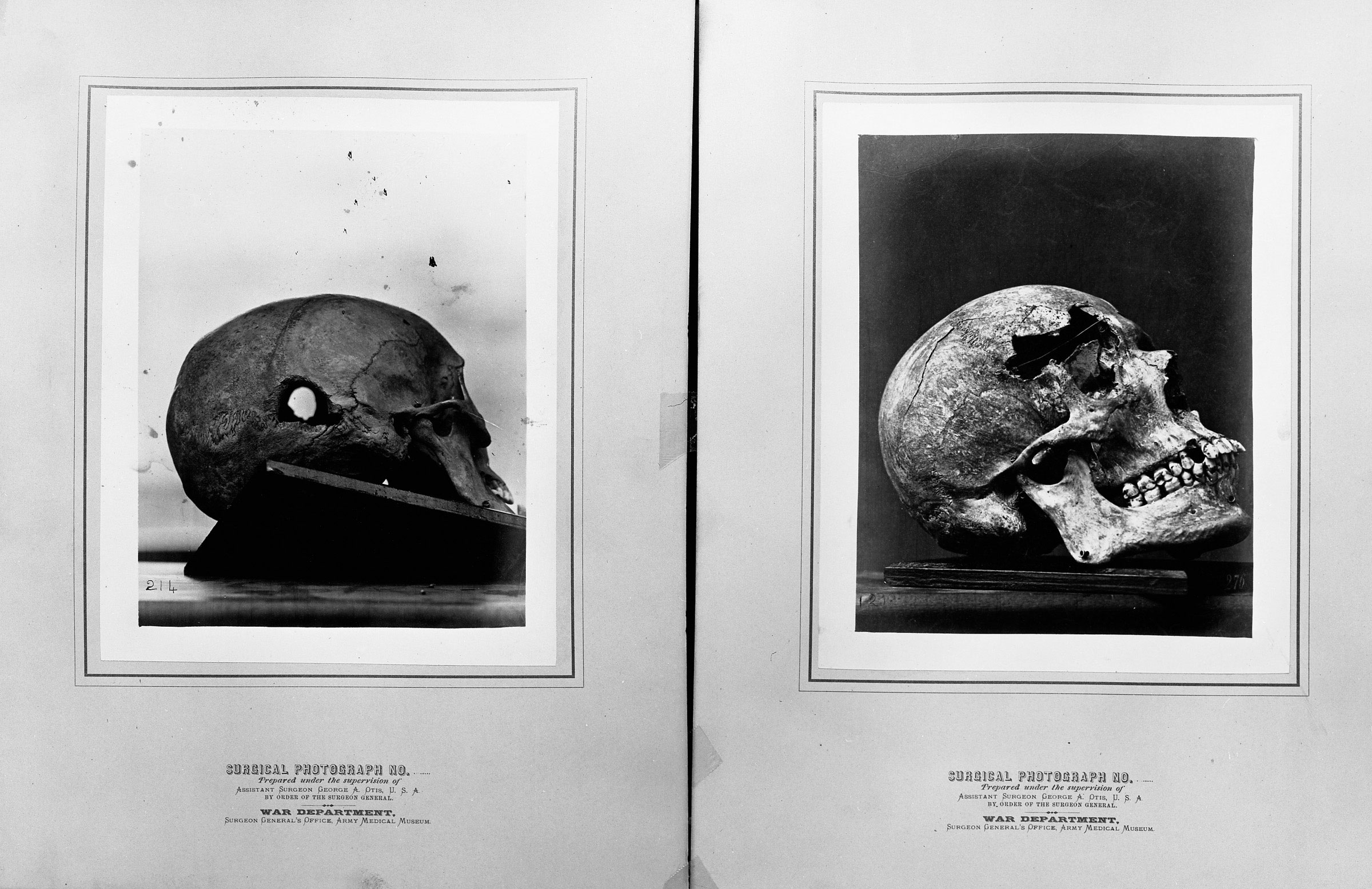 The catastrophic damage caused by the commonly used cone-shaped bullet is graphically chronicled in this pair of surgical photographs showing the entrance and exit of a minié ball.