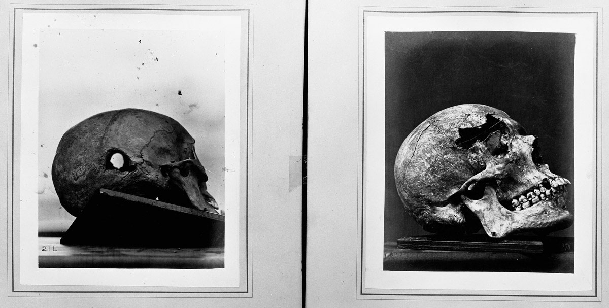 The catastrophic damage caused by the commonly used cone-shaped bullet is graphically chronicled in this pair of surgical photographs showing the entrance and exit of a minié ball.