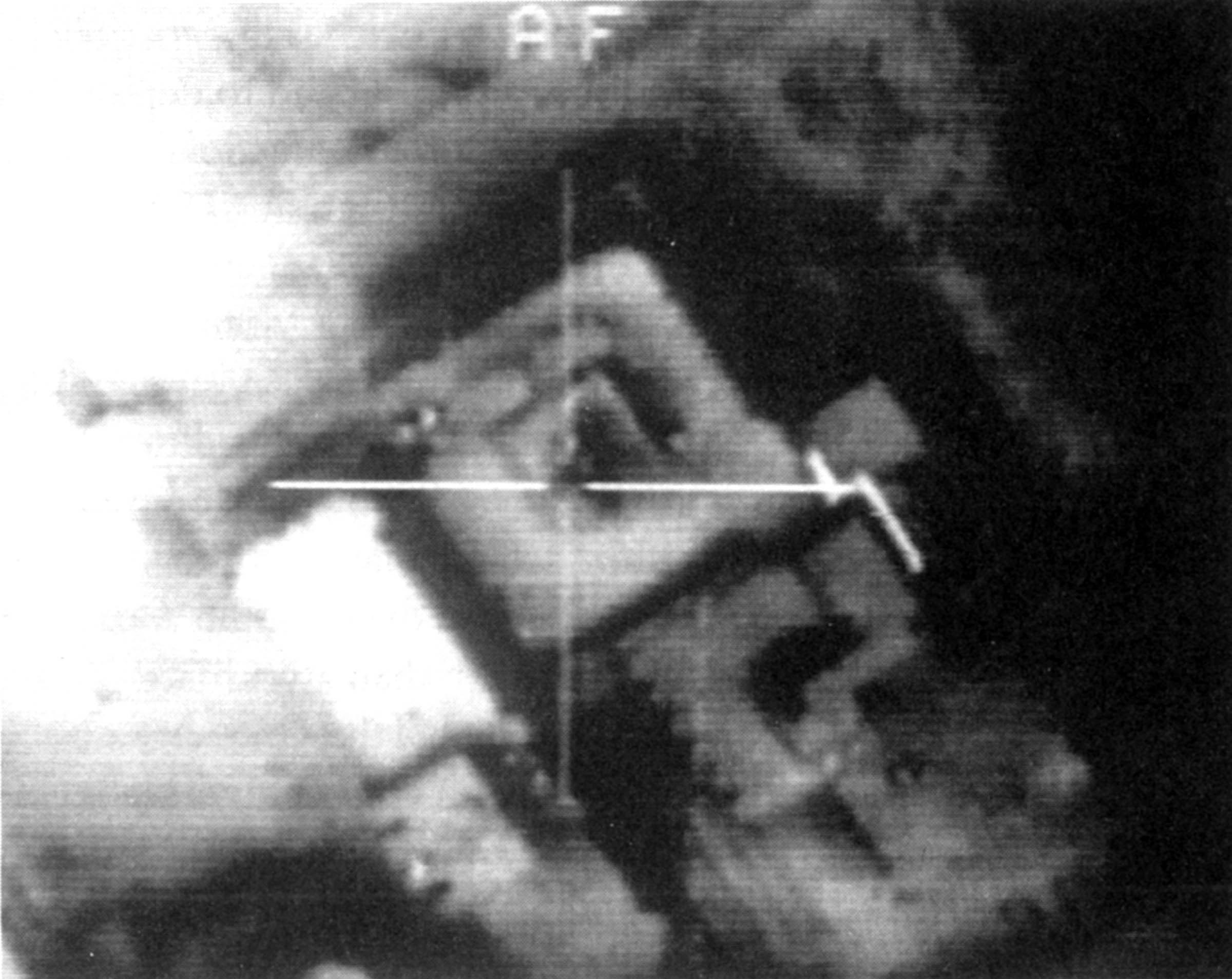 Americans glimpsed the Persian Gulf War largely through television, often seeing images that were in fact composed of other video images. In this case, a video display aboard a Stealth F-117 bomber locks a Glide “smart” bomb’s infrared guidance camera onto a target in Baghdad. The accuracy and glamour of such high-tech weapons were highlighted in news coverage that was heavily censored by the military. Only after the war did the military reveal that “smart” weapons made up only 7 percent of the 81,980 tons of bombs dropped on Iraq and Kuwait—and of that total figure, 70 percent, or 62,137 tons, missed their targets.